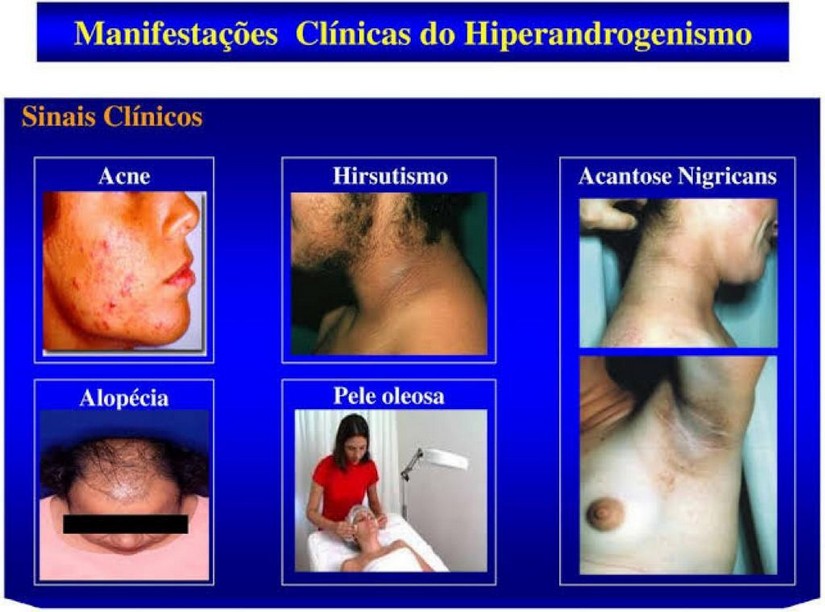 Manifestaçoes do Hiperandrogenismo